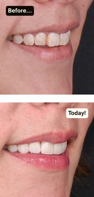before and after of teeth veneers in san diego, california
