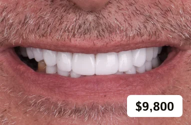 Full arch smile makeover package with emax porcelain veneers for upper jaw.