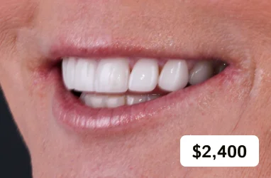 Same-day dental veneers. Smile makeover package including placement of 2 emax porcelain veneers.