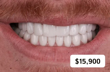 Full mouth smile makeover package with emax porcelain veneers for upper and lower jaw.