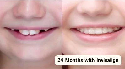 Before and after results of Invisalign treatment in San Diego
