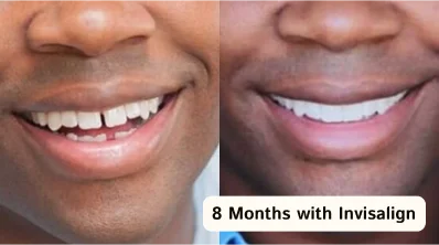 Smile transformation with Invisalign clear aligners in San Diego