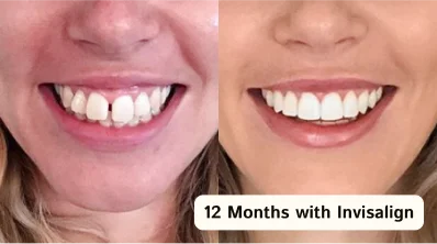 Straighter teeth achieved with Invisalign in San Diego