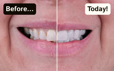 Side-by-side comparison showing teeth before and after a professional whitening treatment.