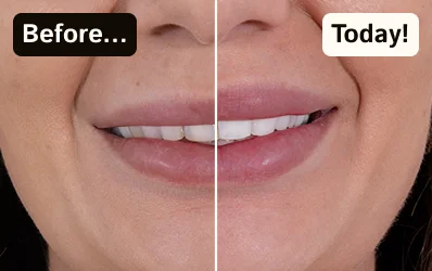 Close-up of a patient's smile before and after teeth whitening.