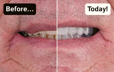 Dramatic transformation of teeth color with a before-and-after whitening treatment.