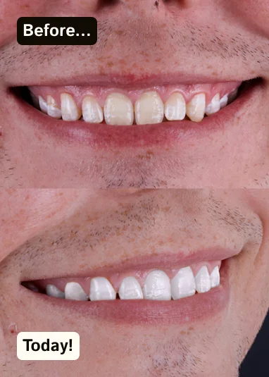 A San Diego patient’s smile transformation from a professional whitening treatment.