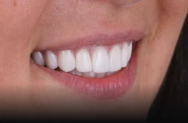 Final step of the whitening process, revealing a brighter smile